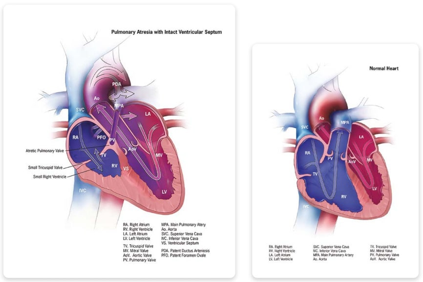 Pulmonary valve atresia