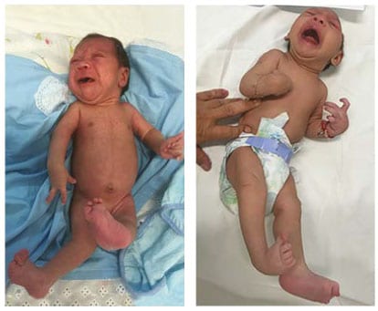 Newborn infant with bilateral contractures of the hips and knees, bilateral talipes calcaneovalgus, and anterior dislocation of the knees.