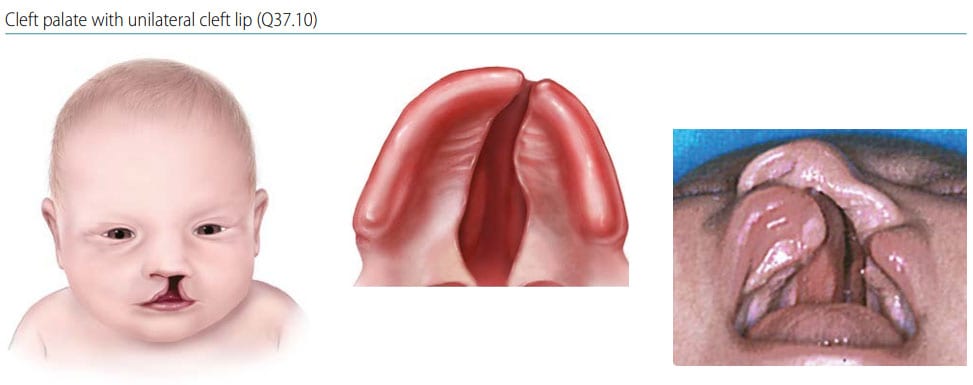 Fig. 27. Cleft palate with cleft lip