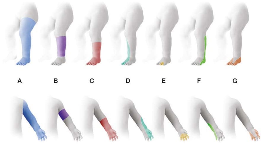 Fig. 35. Types of limb deficiencies by axis and segment involved