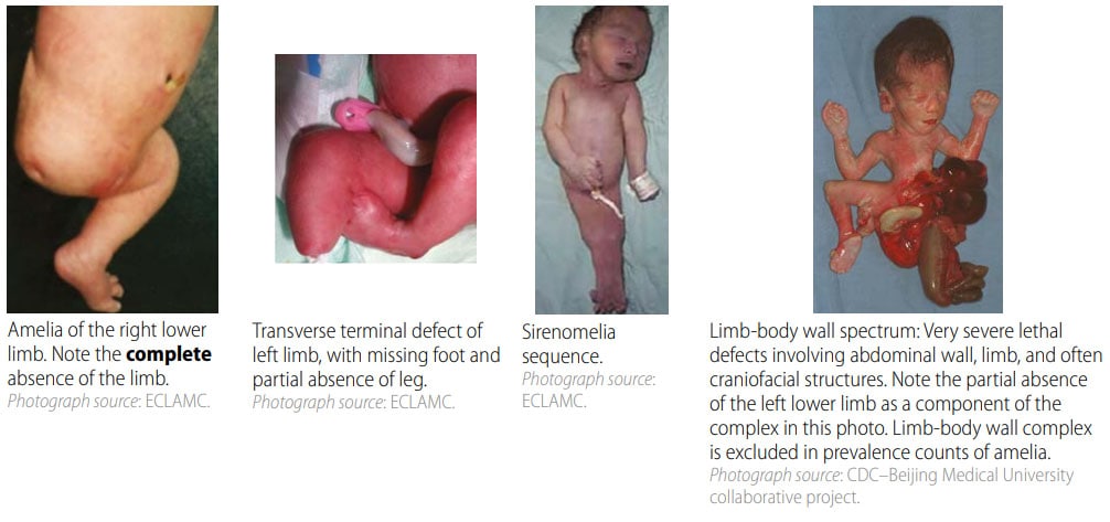 Fig. 37. Distinguishing amelia from other congenital anomalies