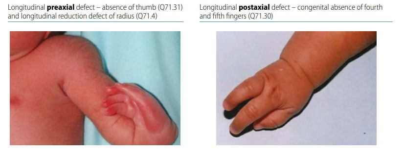 Fig. 43. Distinguishing longitudinal preaxial defects from longitudinal postaxial defects (side-by-side comparison)