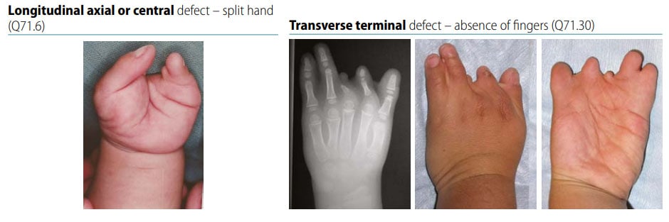 Fig. 45. Distinguishing longitudinal axial defects from transverse terminal defects of hand (side-by-side comparison)