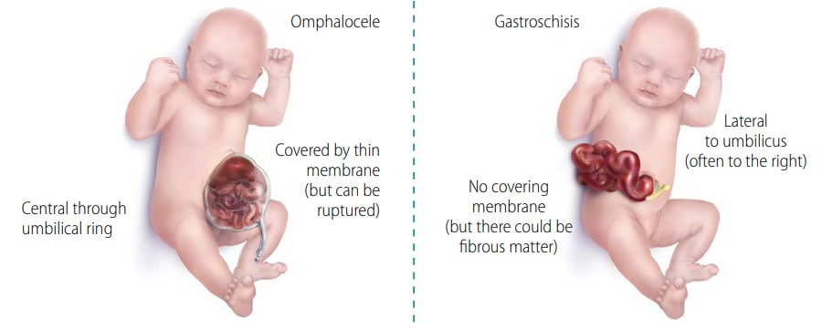 Fig. 49. Distinguishing omphalocele from gastroschisis