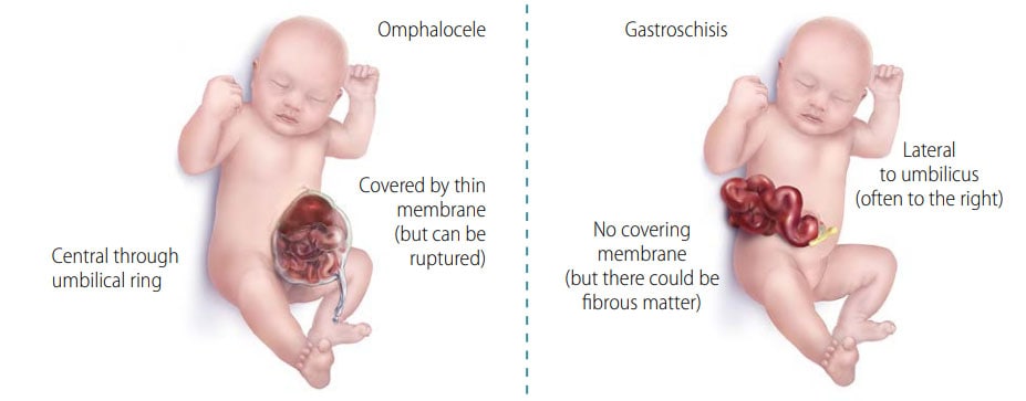Fig. 51. Distinguishing omphalocele from gastroschisis