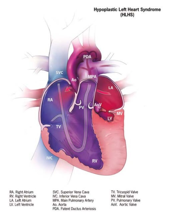 Fig. 19. Hypoplastic left heart syndrome