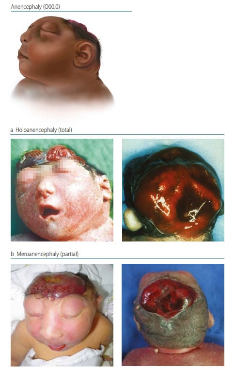 Fig. 2. Anencephaly