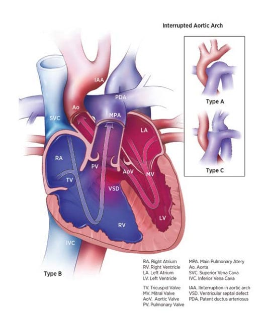 Fig. 20. Interrupted aortic arch
