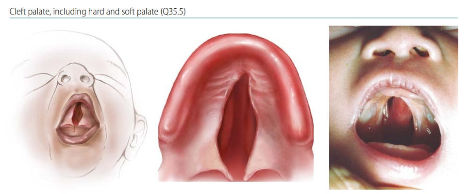 Fig. 21. Cleft palate