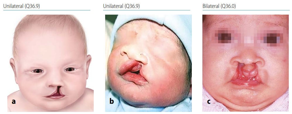 Fig. 24. Cleft lip 