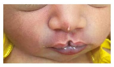 Fig. 26. Median cleft lip