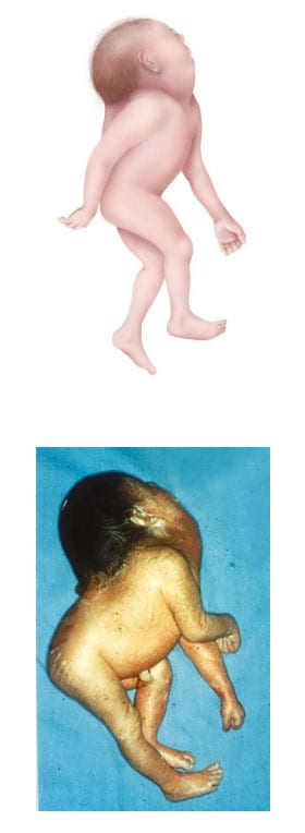 Fig. 4. Iniencephaly