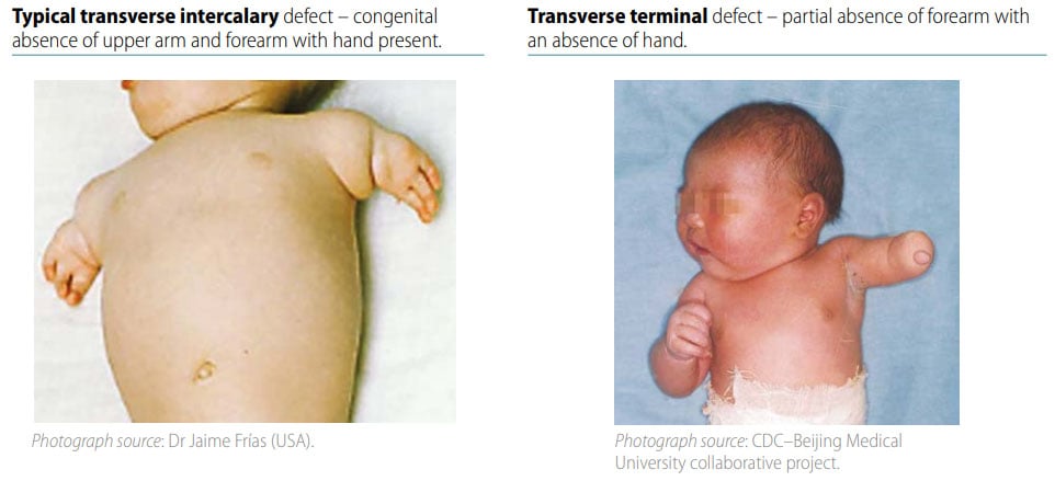 Fig. 41. Distinguishing intercalary defects from transverse terminal defects (side-by-side comparison)