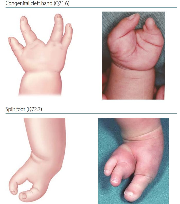 Fig. 44. Longitudinal axial defects (split hand and foot)