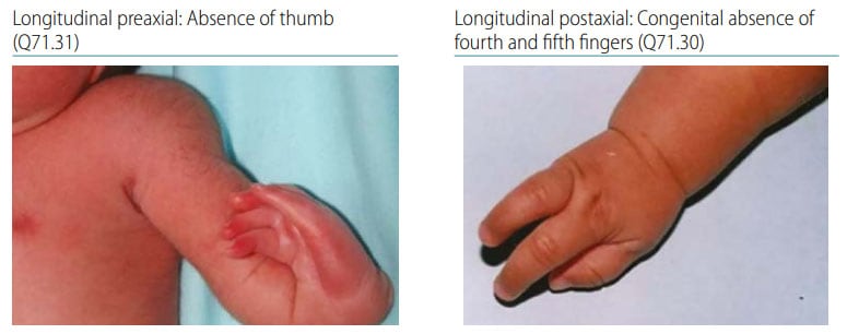Fig. 47. Distinguishing longitudinal postaxial defects from longitudinal preaxial defects (side-by-side comparison)
