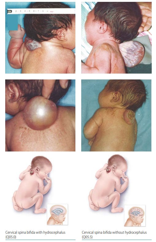Fig. 7. Cervical spina bifida