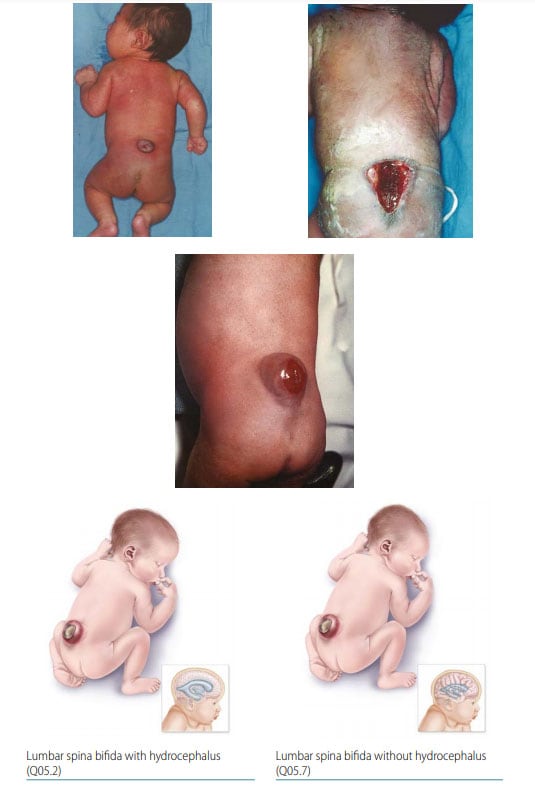 Fig. 9. Lumbar spina bifida