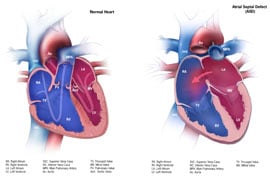 Picture of Atrial Septal Defect and a normal heart