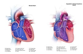 Picture of Hypoplastic Left Heart Syndrome and a normal heart