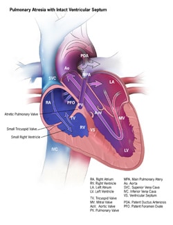 Congenital Heart Defects Facts About Pulmonary Atresia Cdc - 