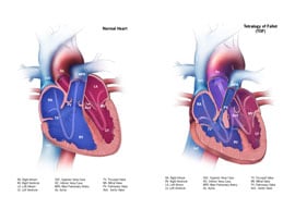 Picture Tetralogy of Fallot