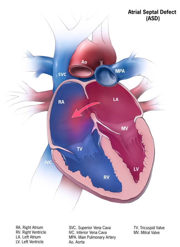Picture of Atrial Septal Defect
