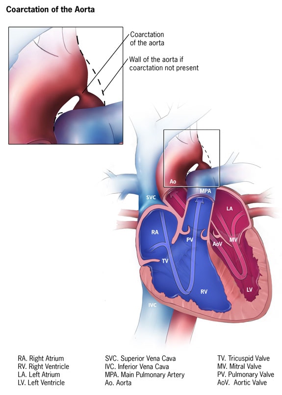 Congenital Heart Defects Facts About Coarctation Of The Aorta Cdc