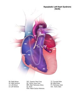 Picture of Hypoplastic Left Heart Syndrome