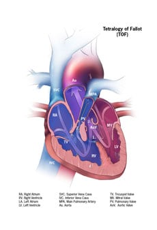 Picture of Tetralogy of Fallot