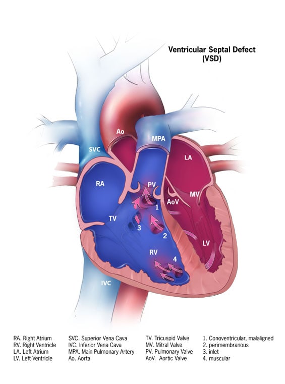 Congenital Heart Defects - Facts about Ventricular Septal Defect | CDC