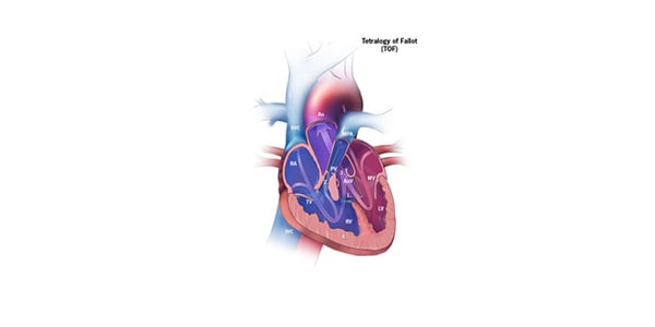 Congenital Heart Defects - Facts about Tetralogy of Fallot | CDC