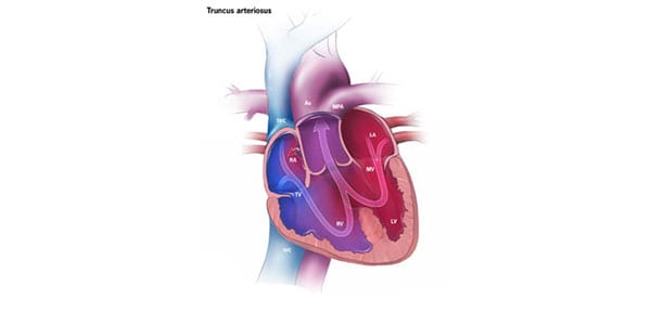 Congenital Heart Defects - Facts about Truncus Arteriosus | CDC