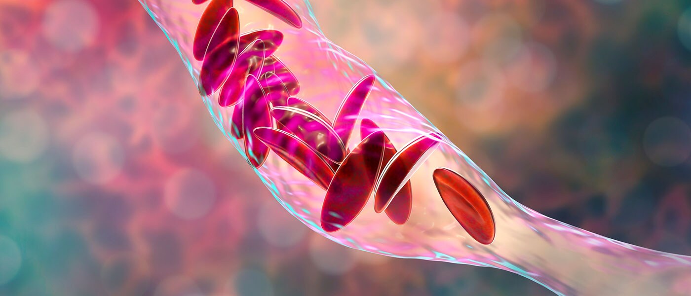 3D illustration showing clumps of sickle cell blocking the blood vessel 