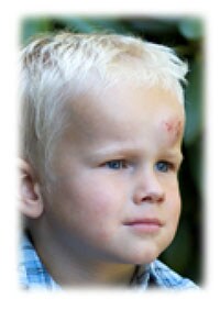 Young boy with scrape on head