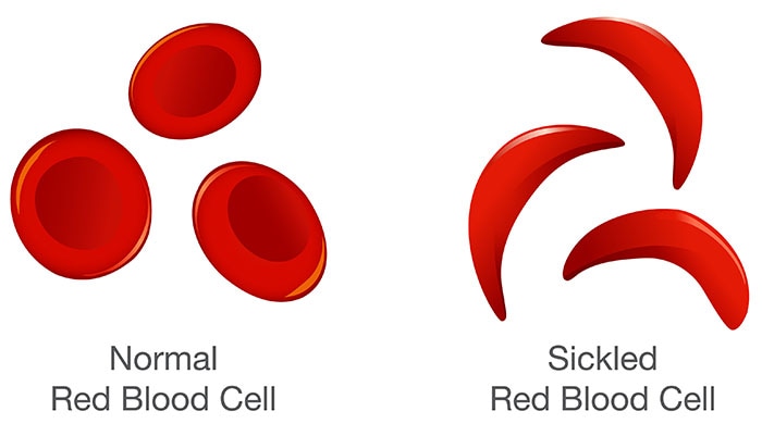 What is Sickle Cell Disease? | CDC