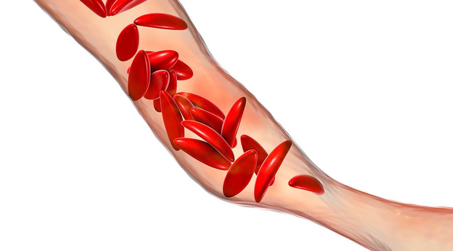 Sickle cell anemia, 3D illustration. Clumps of sickle cell block the blood vessel