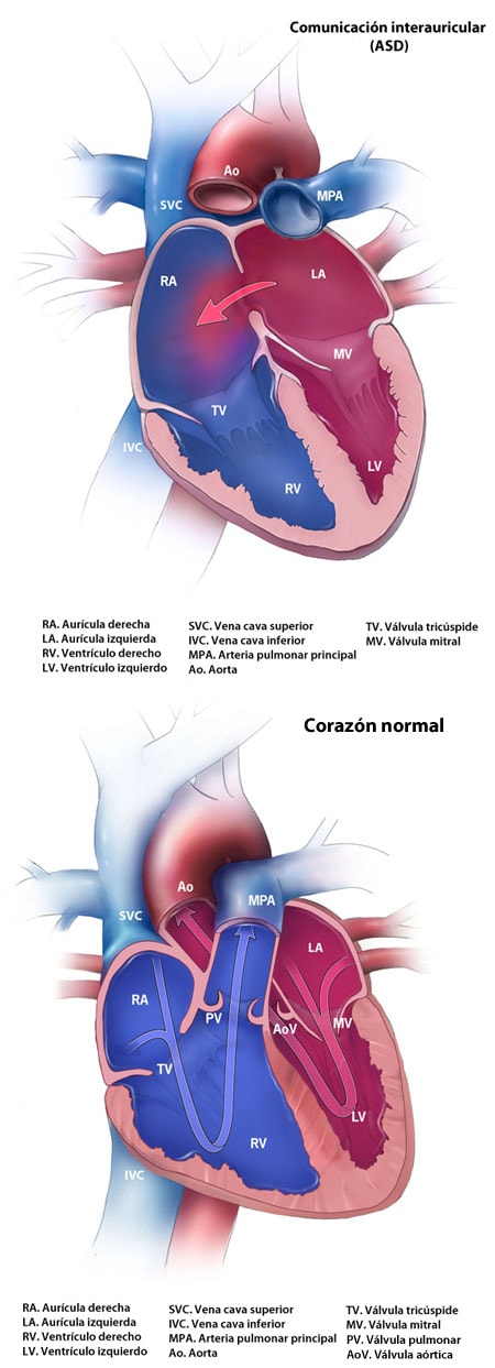 Normal Heart and Atrial Septal Defect