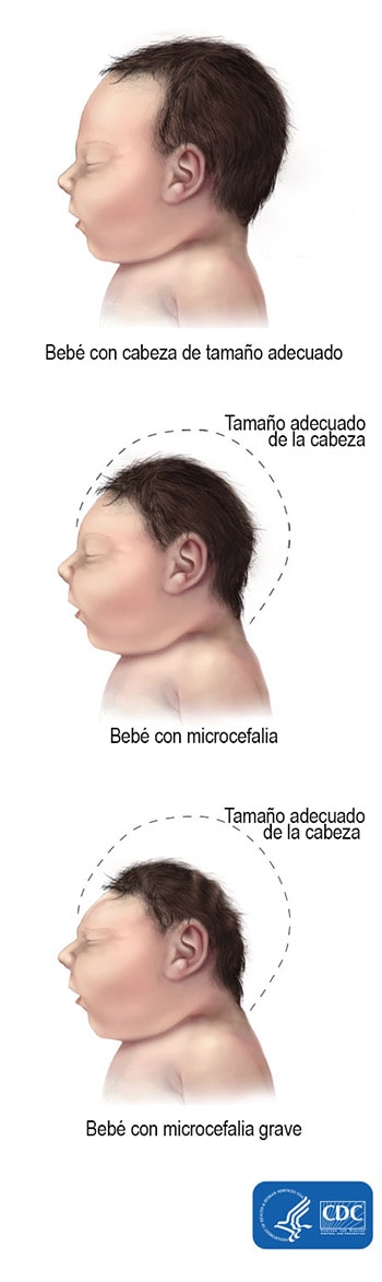 Beb&eacute; con cabeza de tama&ntilde;o normal, Beb&eacute; con microcefalia, Beb&eacute; con microcefalia grave