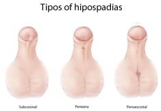 Types of Hypospadias - Subcoronal, Midshaft, and Penoscrotal