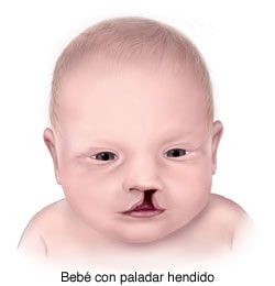 bebÃ© con labio hendido