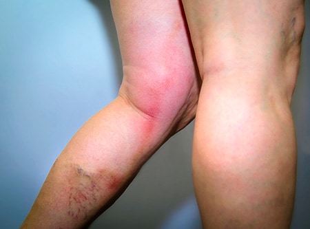 Ejemplo de una persona con un coágulo de sangre en la pierna.