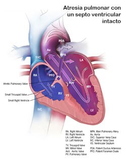 Atresia pulmonar con un septo ventricular intacto