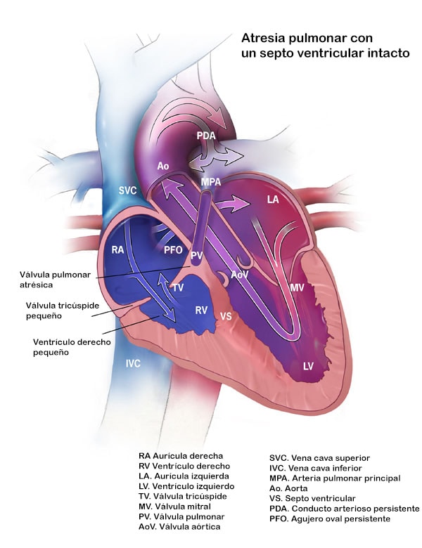 Atresia pulmonar con un septo ventricular intacto