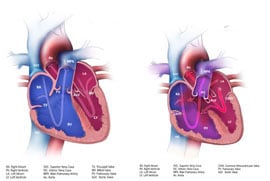 Graphic%26#37;3A%26#37;20Atrioventricular%26#37;20Septal%26#37;20Defect%26#37;20%26#37;28AVSD%26#37;29%26#37;20with%26#37;20a%26#37;20normal%26#37;20heart