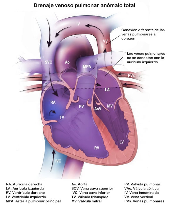 Drenaje venoso pulmonar anómalo total