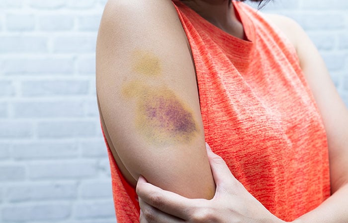 A woman with a bruise on her arm