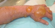 a forearm and hand with golf-ball-sized blisters