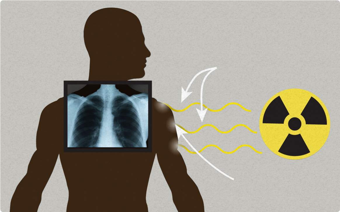 vector graphic showing radiation exposure and x-ray of the lungs