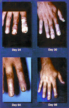 Photo of a human hand damaged by radiation in later stages