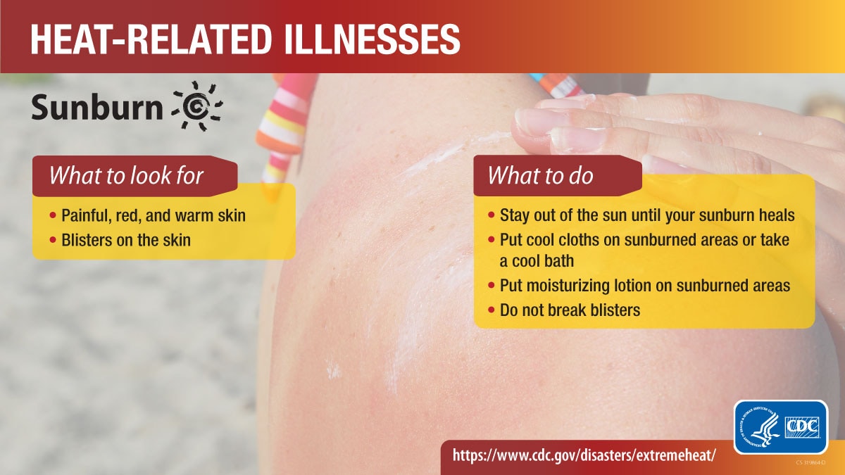 Heat-related illnesses social media graphic for heat sunburn. More info at www.cdc.gov/disasters/extremeheat/